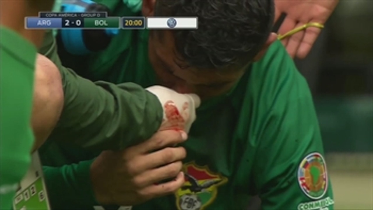 Bolivia's Yasmani Duk gets a bloody nose after a collision against Argentina
