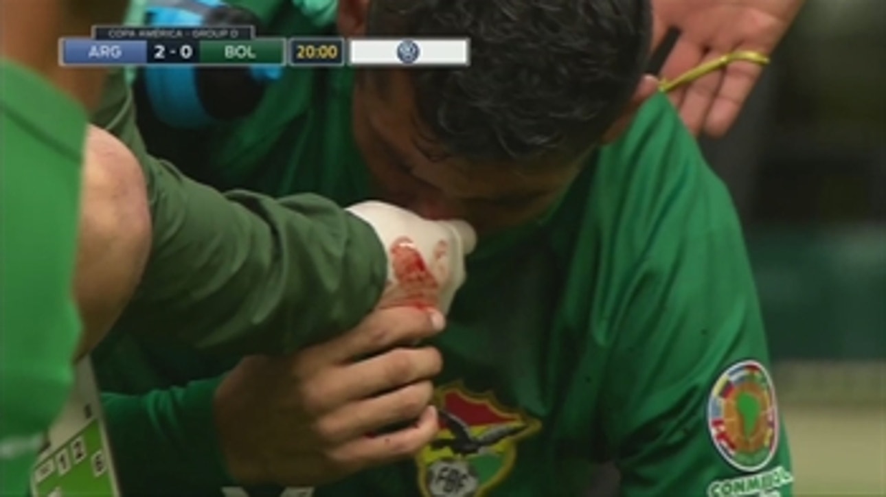 Bolivia's Yasmani Duk gets a bloody nose after a collision against Argentina