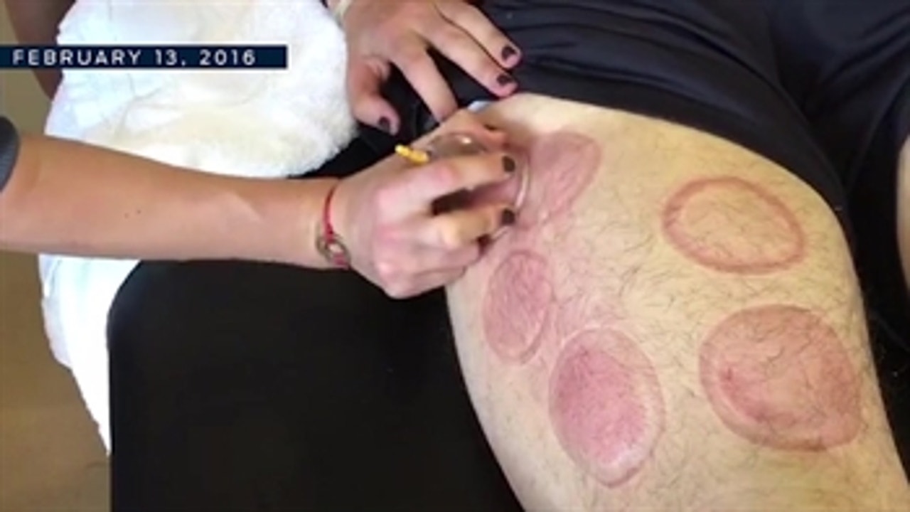 Michael Phelps isn't the only athlete using cupping to get better - PROcast