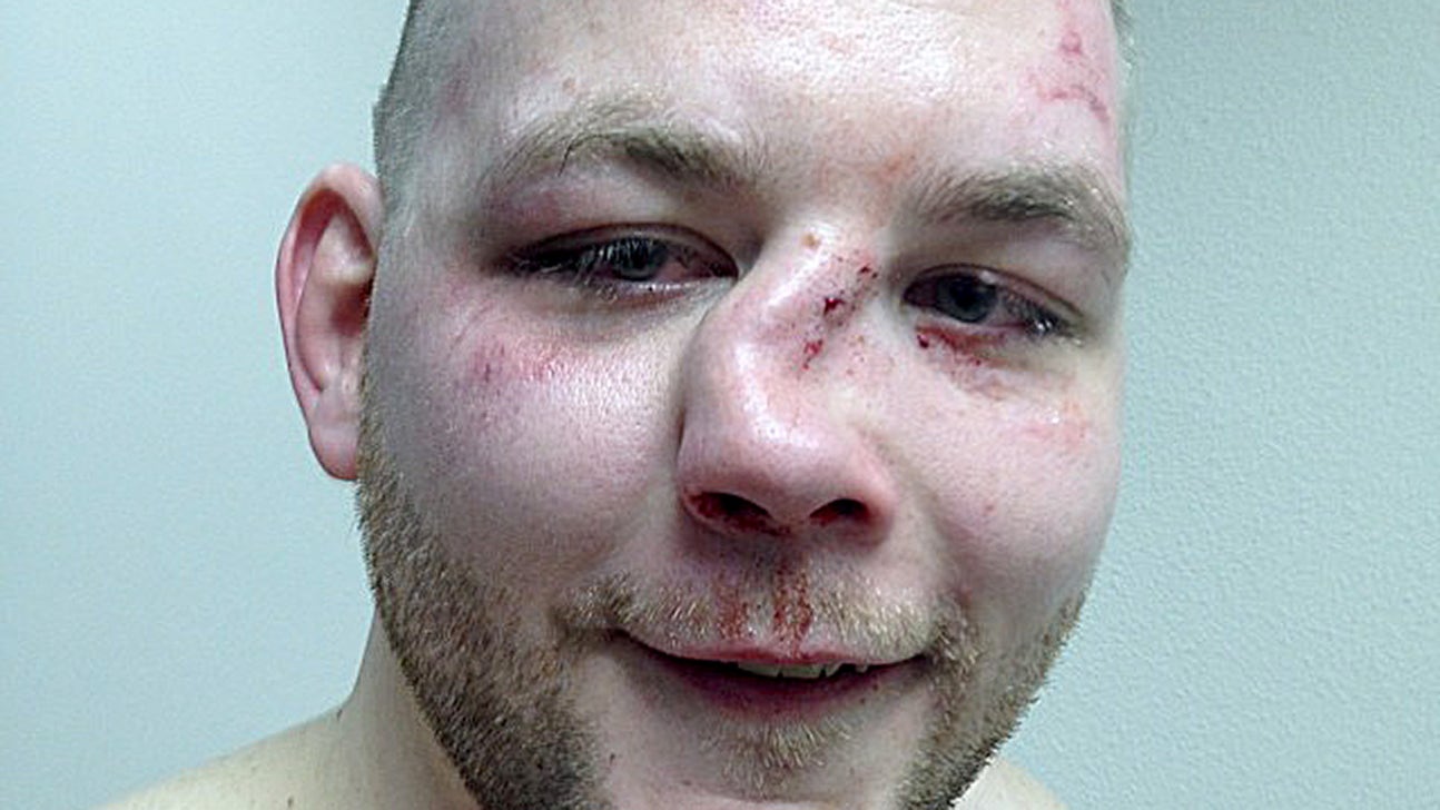 MMA fighter rocks the worst broken nose you've ever seen