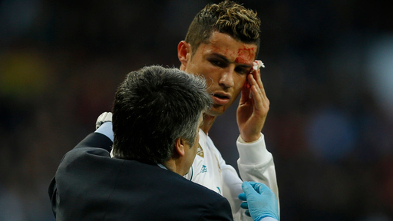 Ronaldo has stitches for face cut in La Liga
