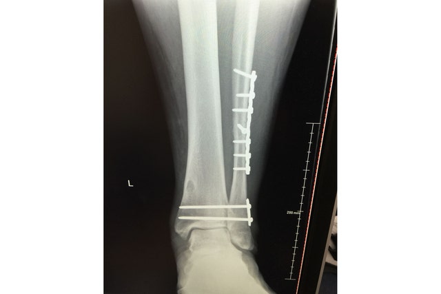 Dak S Injury Hits Especially Hard Fox Sports Dak S Injury Hits Especially Hard Fox Sports